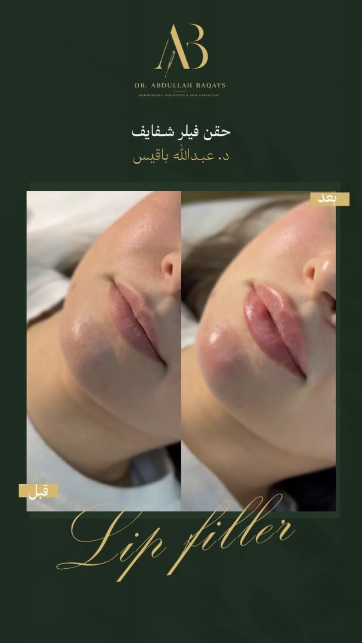 نتيجة حقن فيلر شفايف قبل وبعد — حالة 3 — د. عبدالله باقيس | Lip Filler results