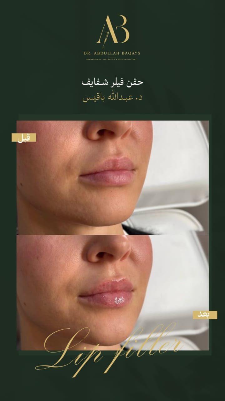 نتيجة حقن فيلر شفايف — حالة 6 — د. عبدالله باقيس